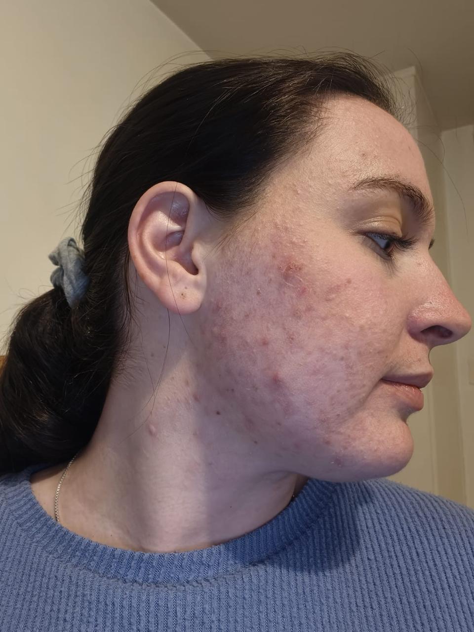 Before Treatment